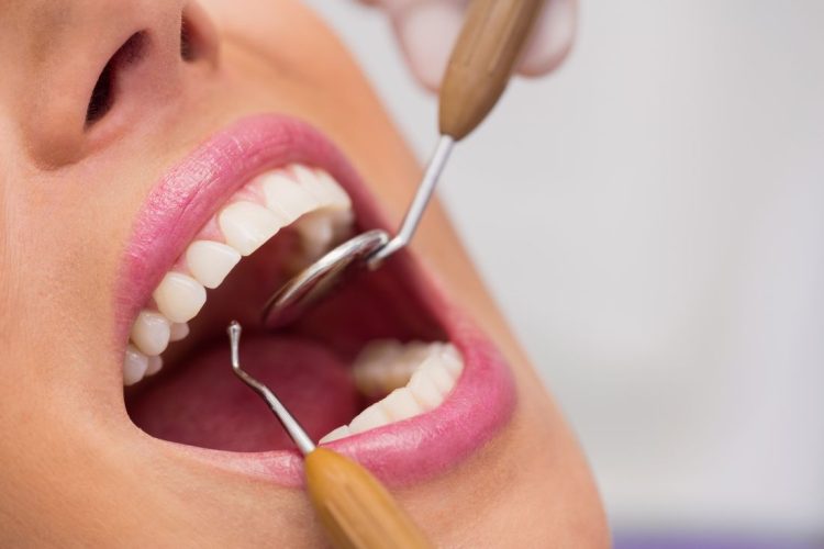 Zabieg periodontologiczny – oczyszczanie kieszonek dziąsłowych